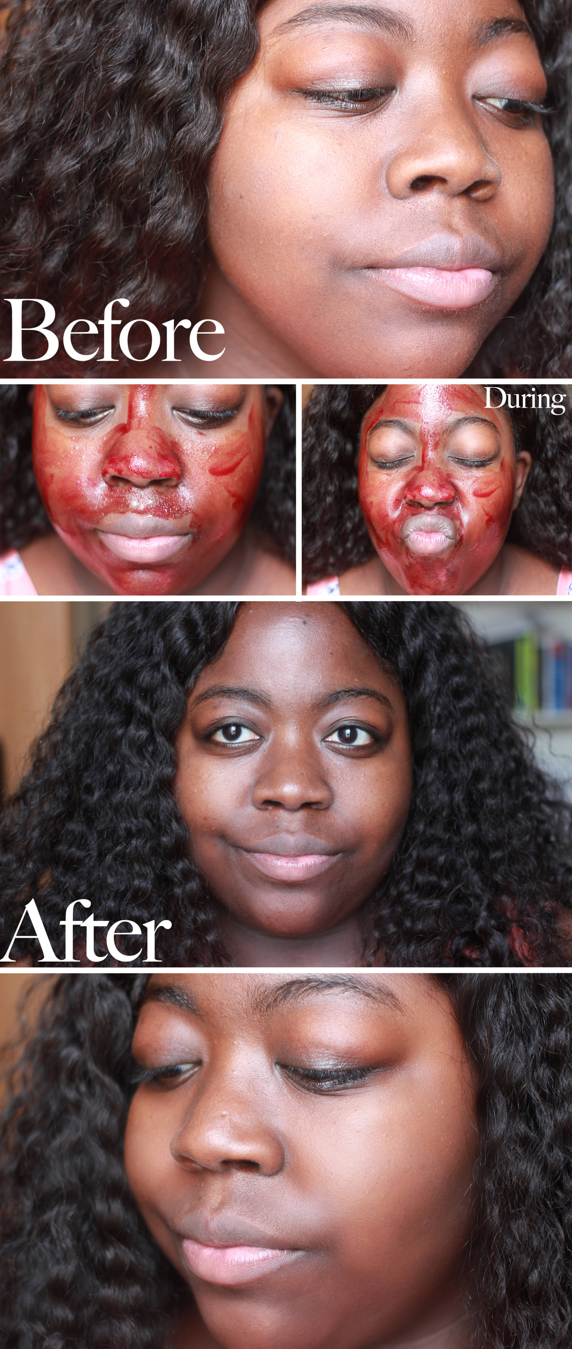 the ordinary peeling solution blackheads